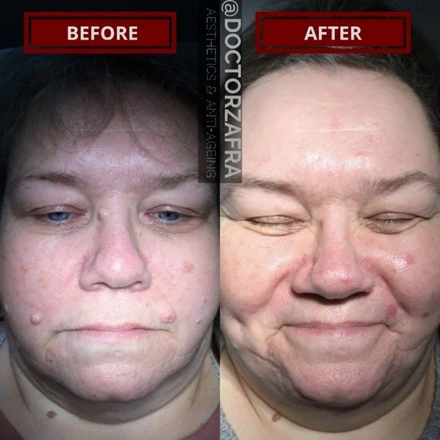 moles-removal-before-after-woman.jpg