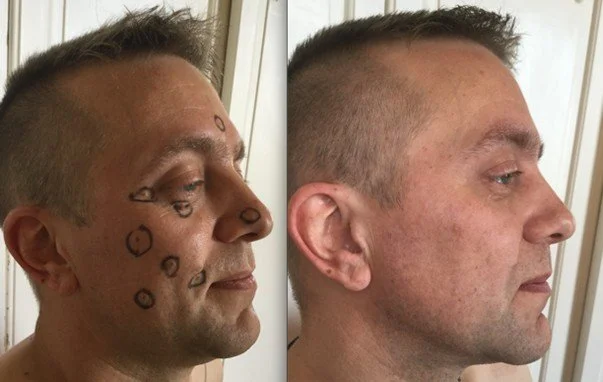 moles-removal-before-after-man.jpg