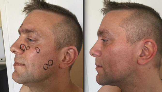 moles-removal-before-after-man-2.jpg