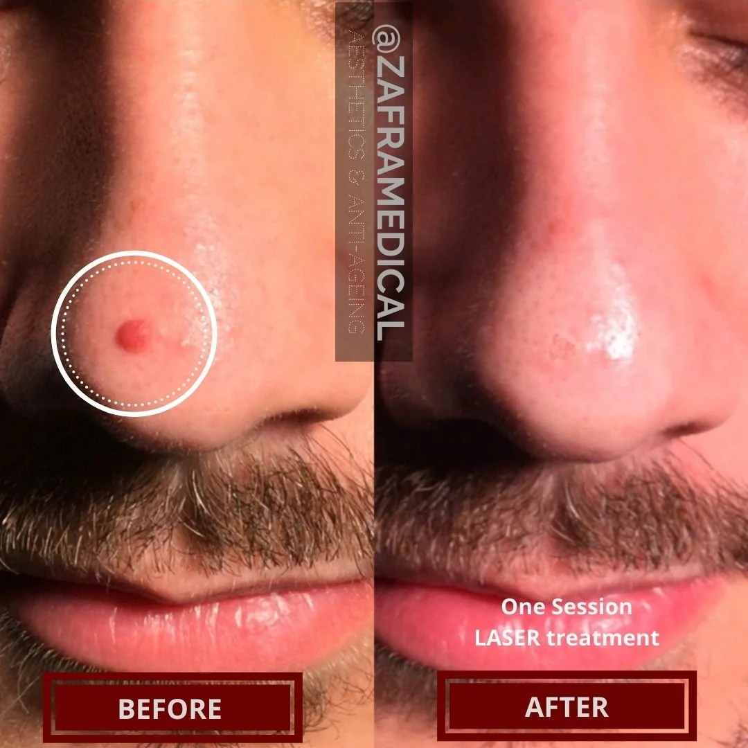 mole-removal-before-and-after-face-case-2.jpg