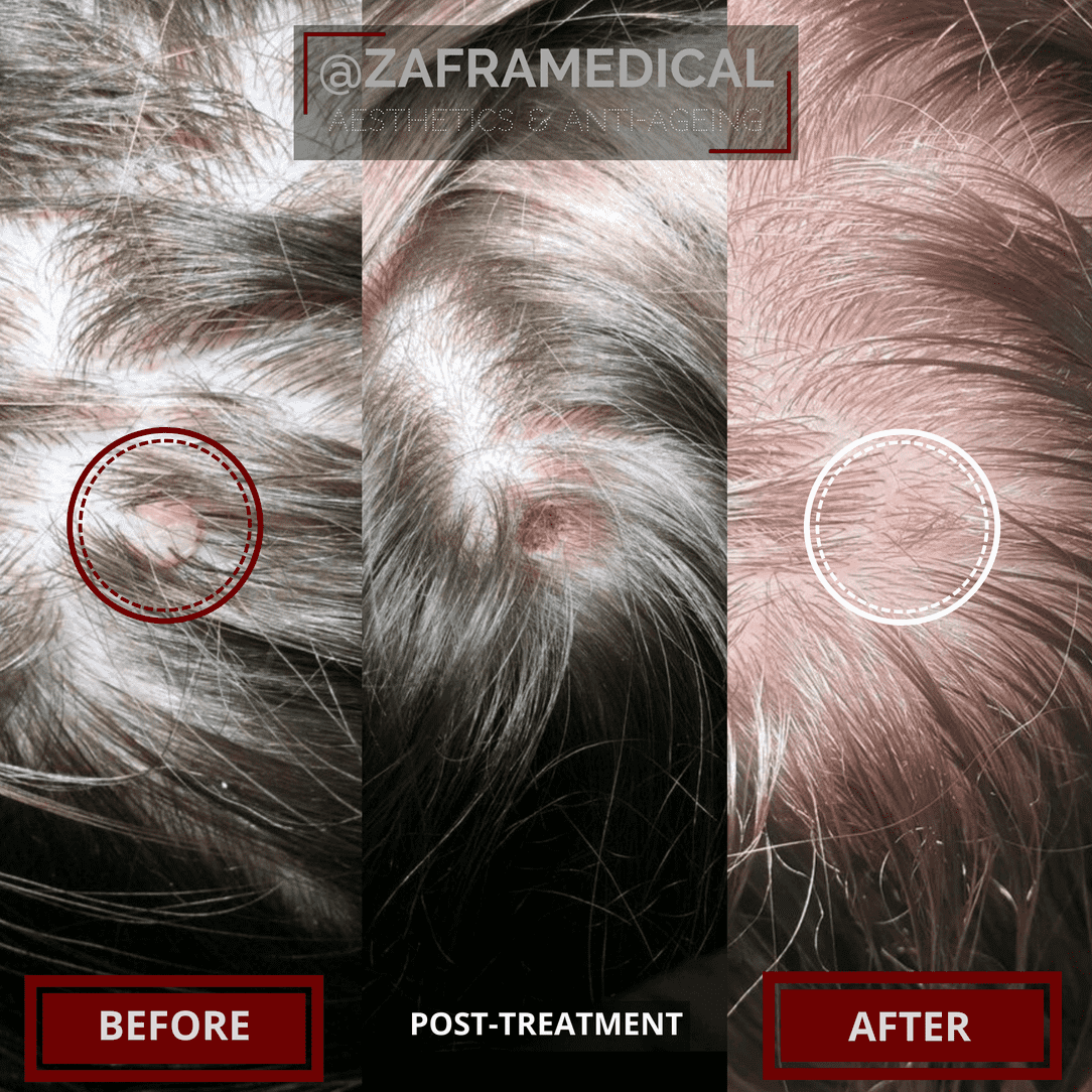 mole-removal-treatment-results-face-case-4.png