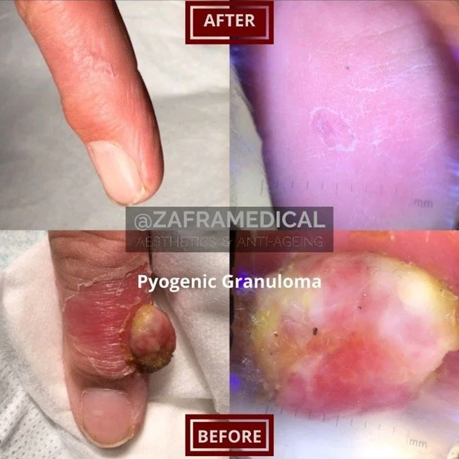 pyogenic-granuloma-removal.jpg