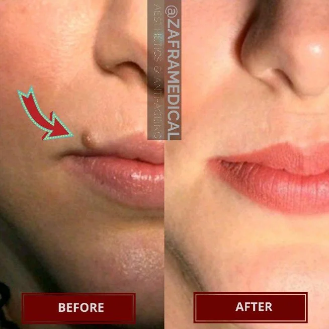 lip-mole-removal-before-after.jpg
