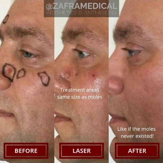 laser-before-after.jpg