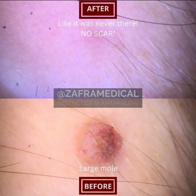 mole-removal-skin.jpg