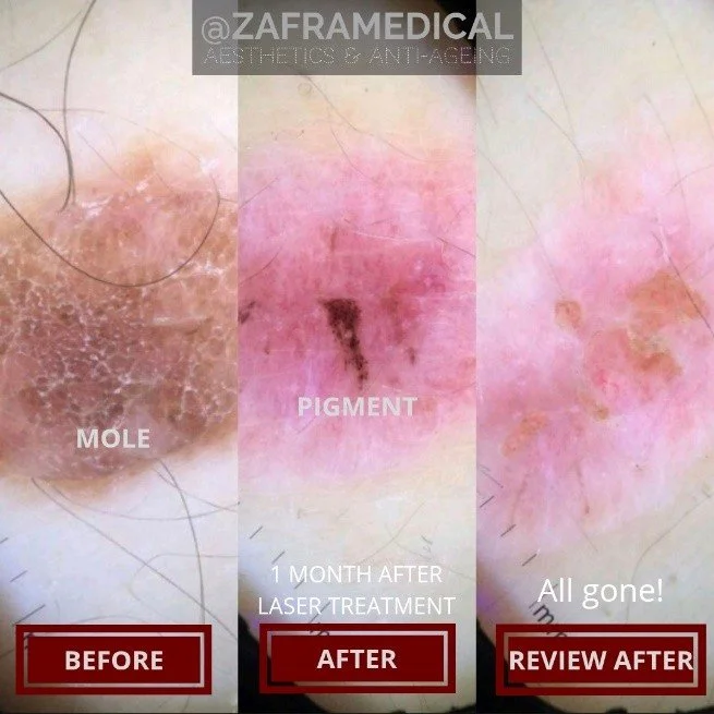 mole-removal-skin-months-after.jpg