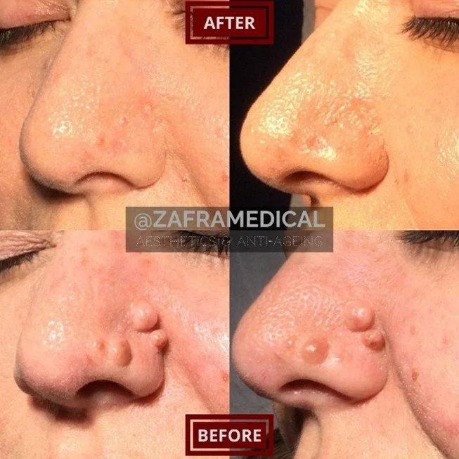 nose-multiple-moles-removal.jpg