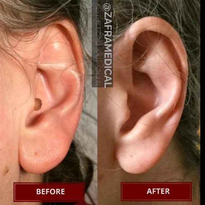 ear-mole-removal.jpg