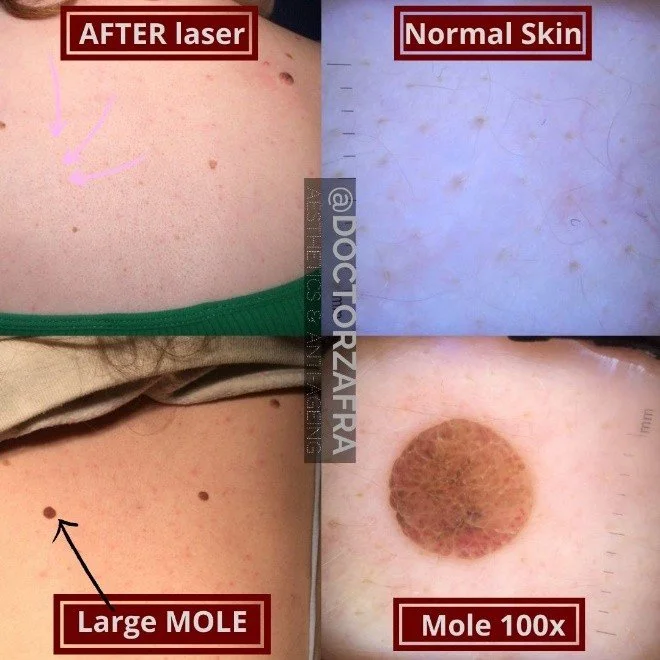 large-mole-removal.jpg