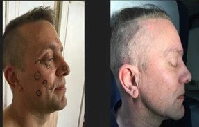 man-face-mole-removal.jpg