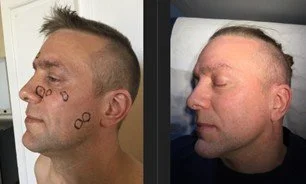 man-face-mole-removal-2.jpg
