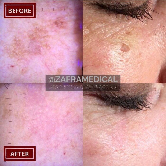 Benign Skin Lesion laser removal sun damage.jpg