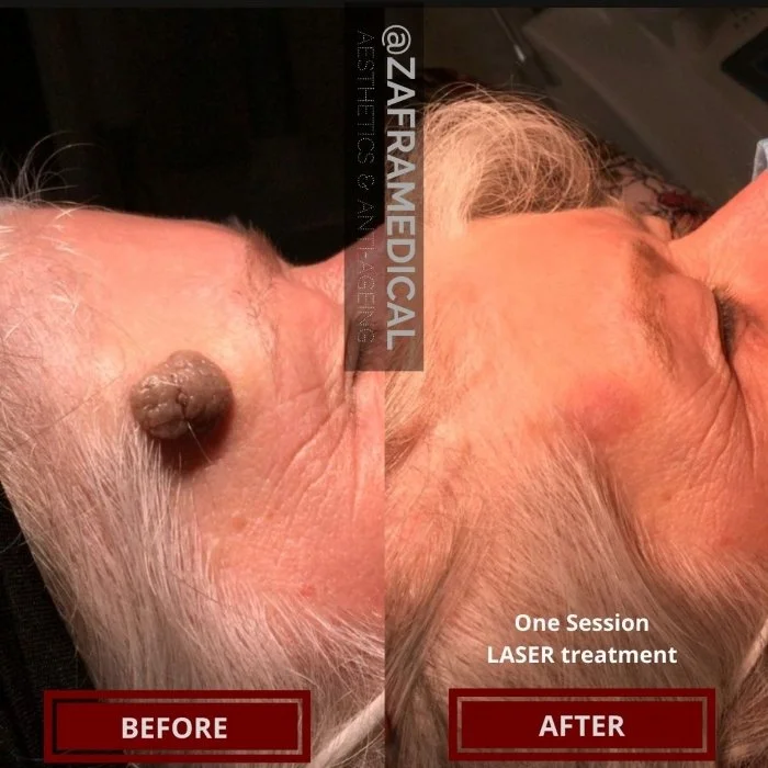 Benign Skin Lesion laser removal large mole forehead.jpg