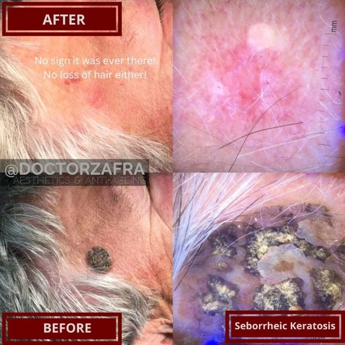 Benign Skin Lesion laser removal seborrheic keratosis.jpg