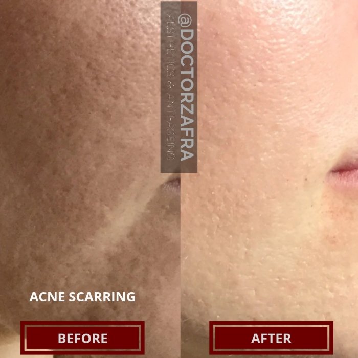 CO2 Laser Acne Scarring treatment.jpg