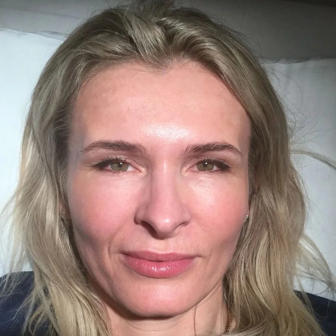 co2-laser-skin-resurfacing-after-woman-face-1.jpg