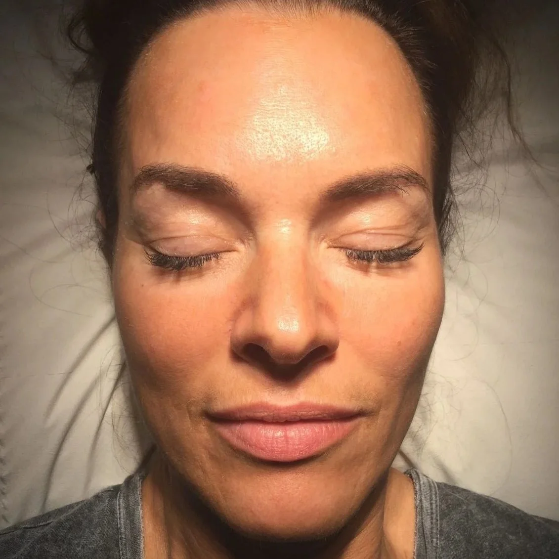 co2-laser-facial-rejuvenation-after-woman-face-3.jpg