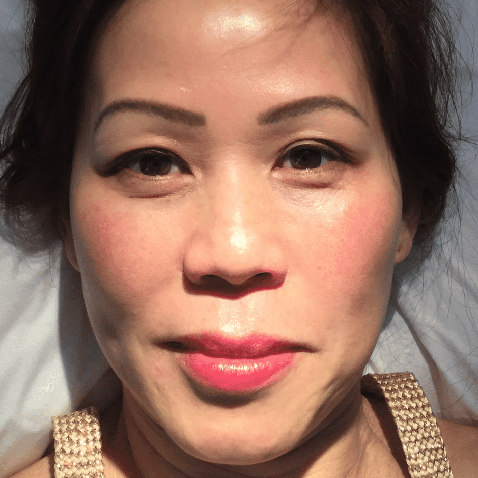 co2-laser-skin-treatment-after-woman-face-6.png