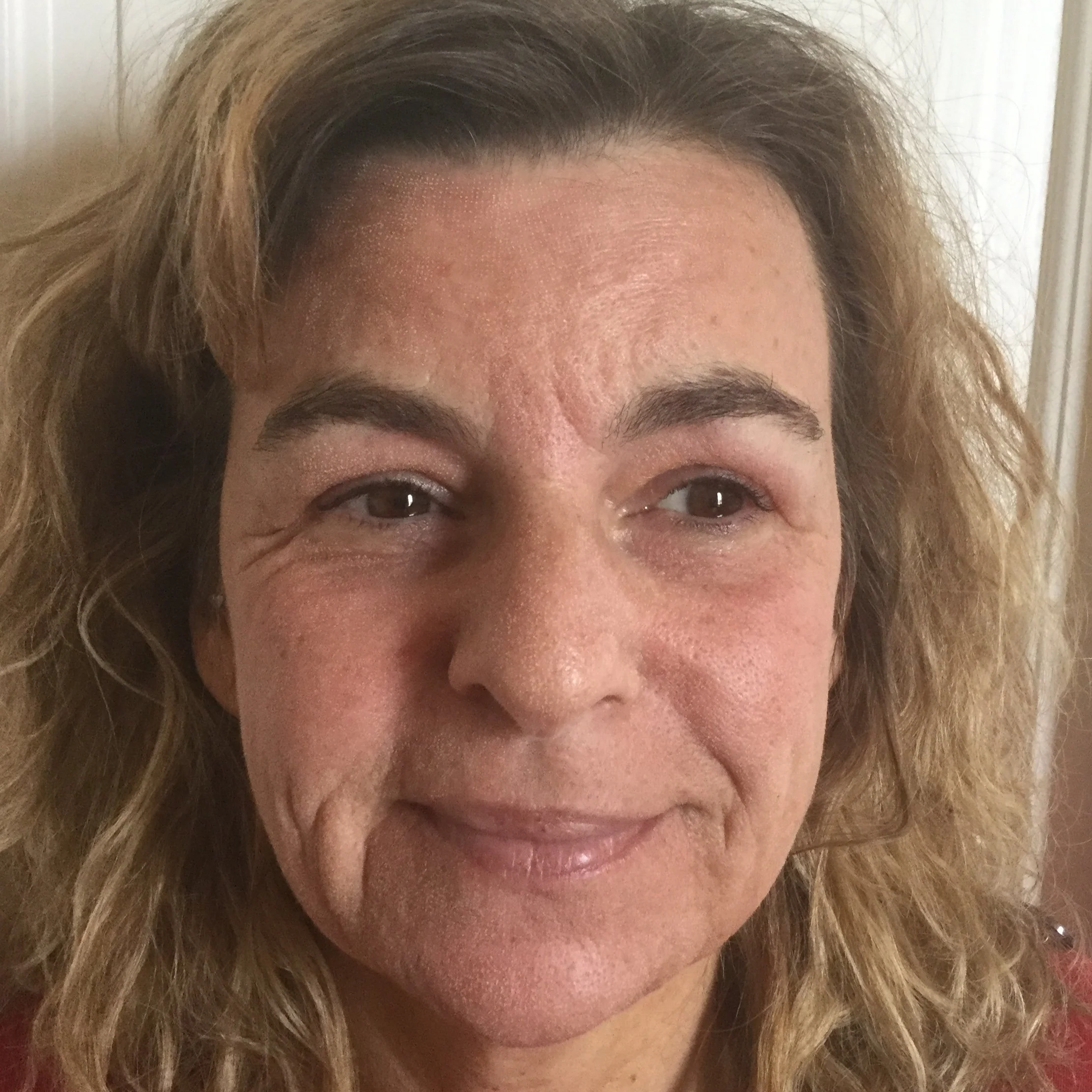5AA+BEFORE+CO2+laser+woman+face+after.png