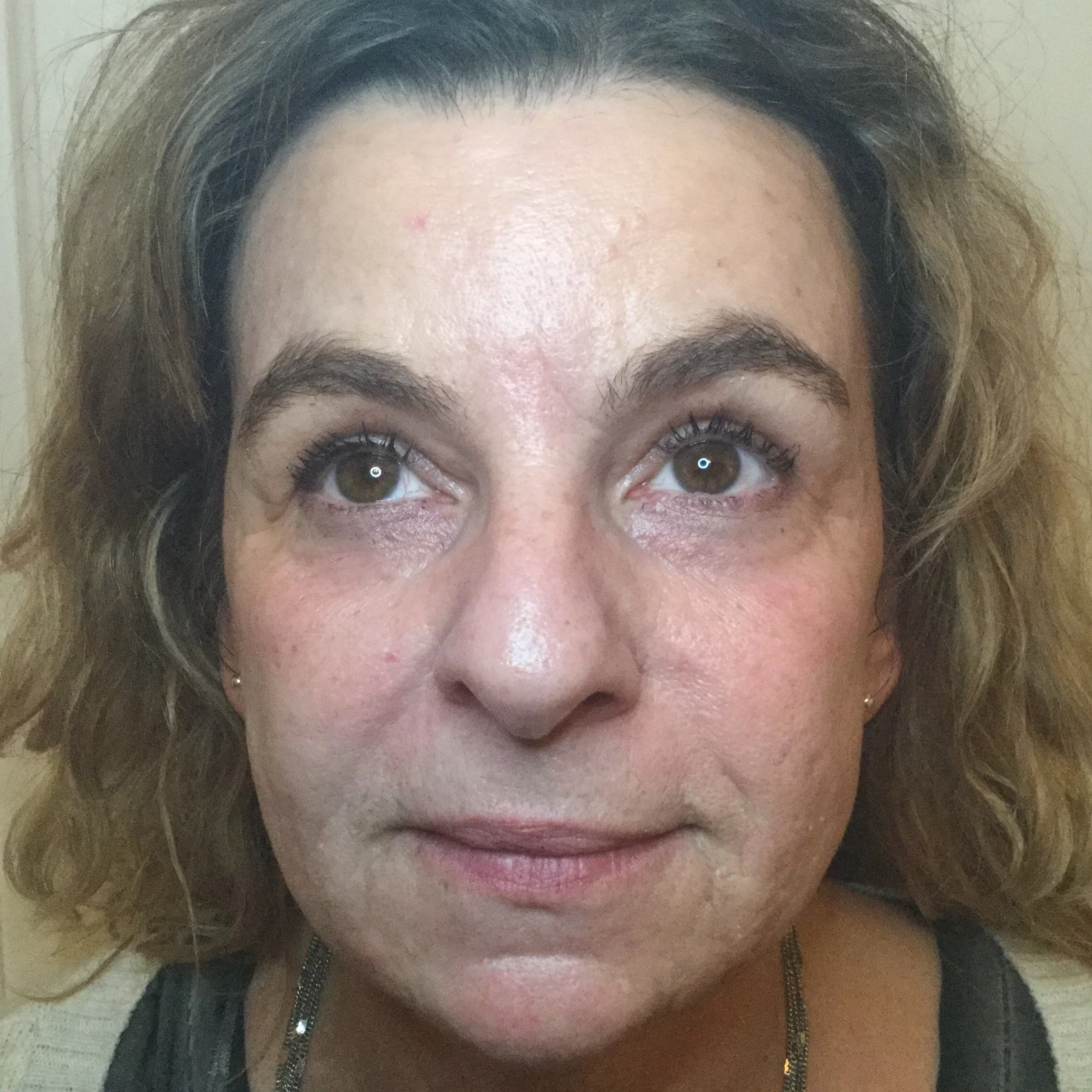 5AB+AFTER+CO2+laser+woman+face+after.png