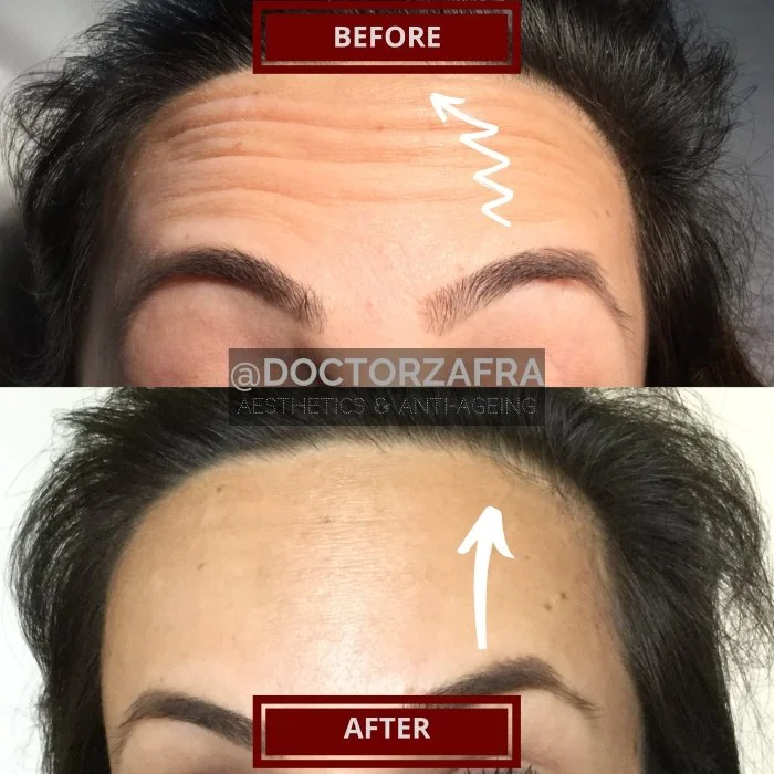 Anti-wrinkle injection 2 areas forehead and frown.jpg