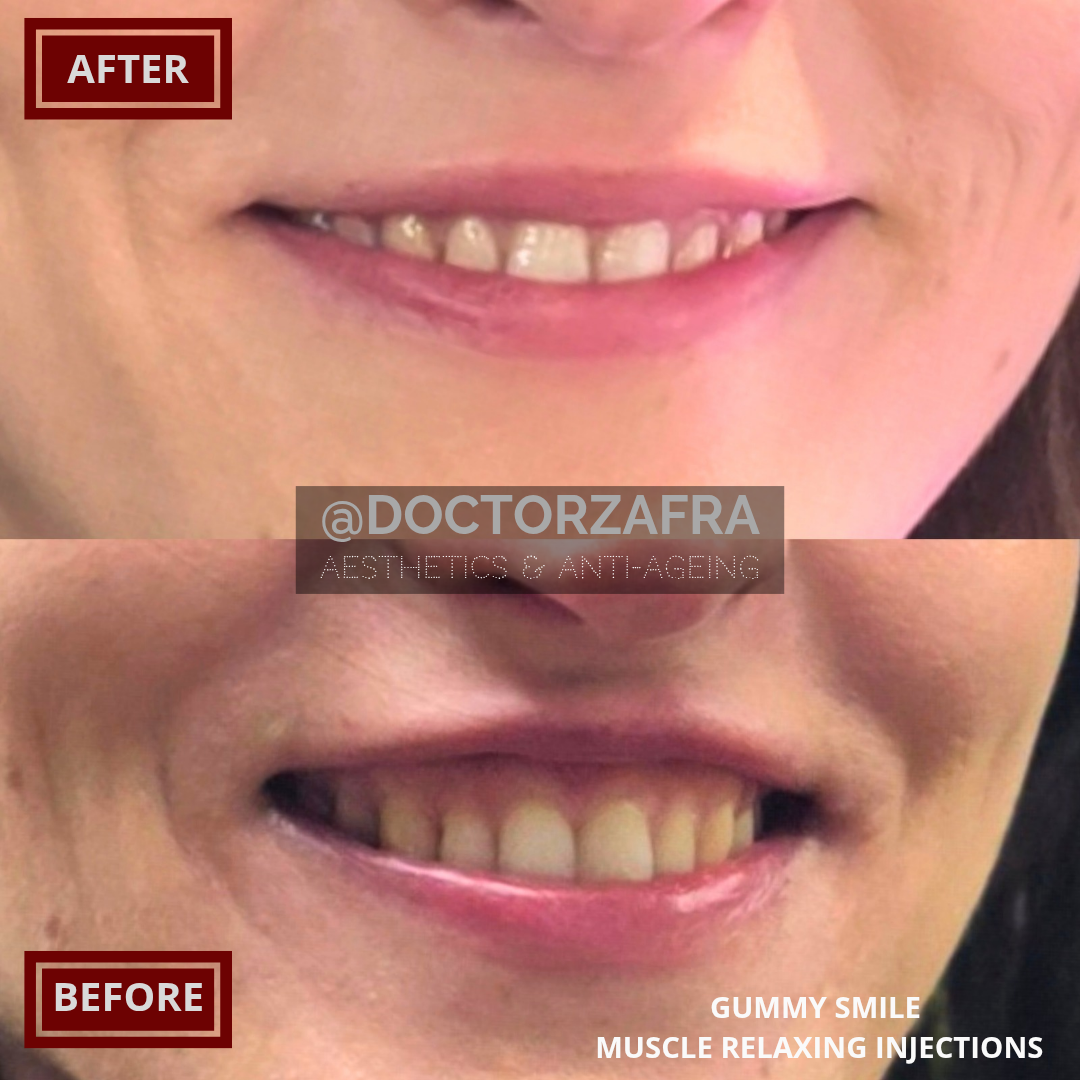 Anti wrinkle Muscle relaxing injections Gummy smile 1.png