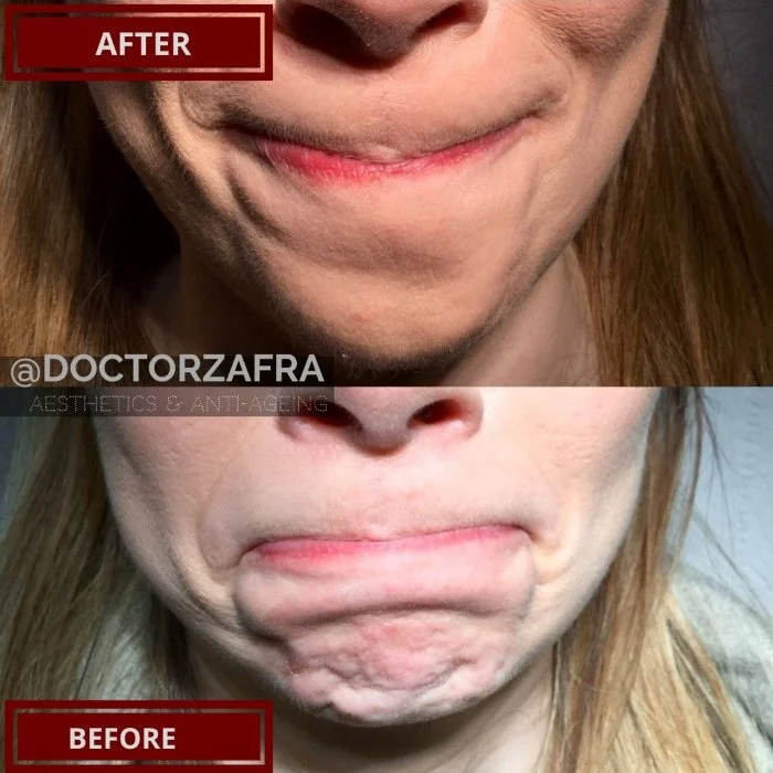 Anti-wrinkle injection chin.jpg