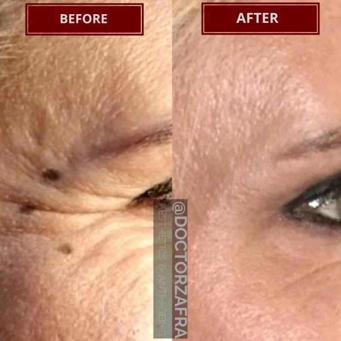 Anti-wrinkle injection crows feet.jpg