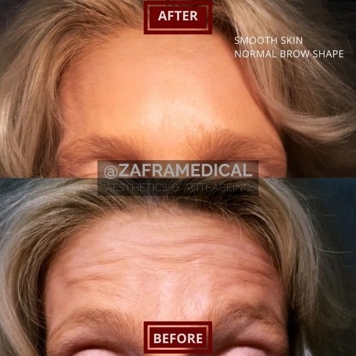 Anti-wrinkle injection forehead  3.jpg