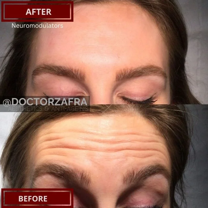 Anti-wrinkle injection forehead 2.jpg