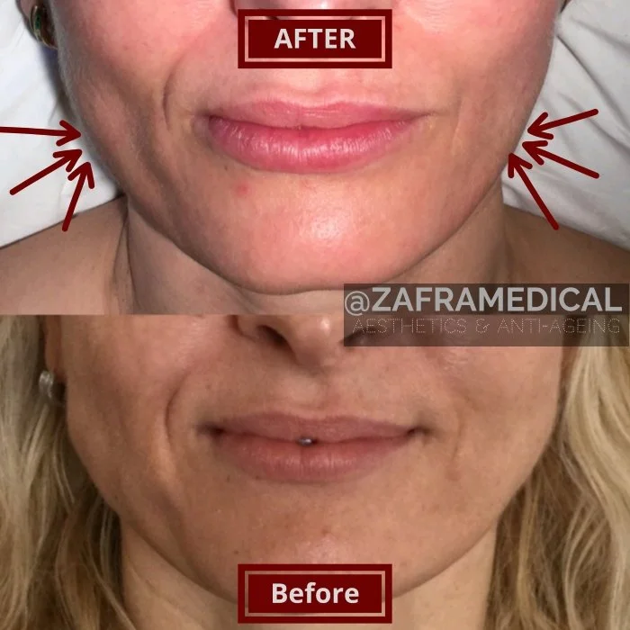 Anti-wrinkle injection jaw slimming 2.jpg