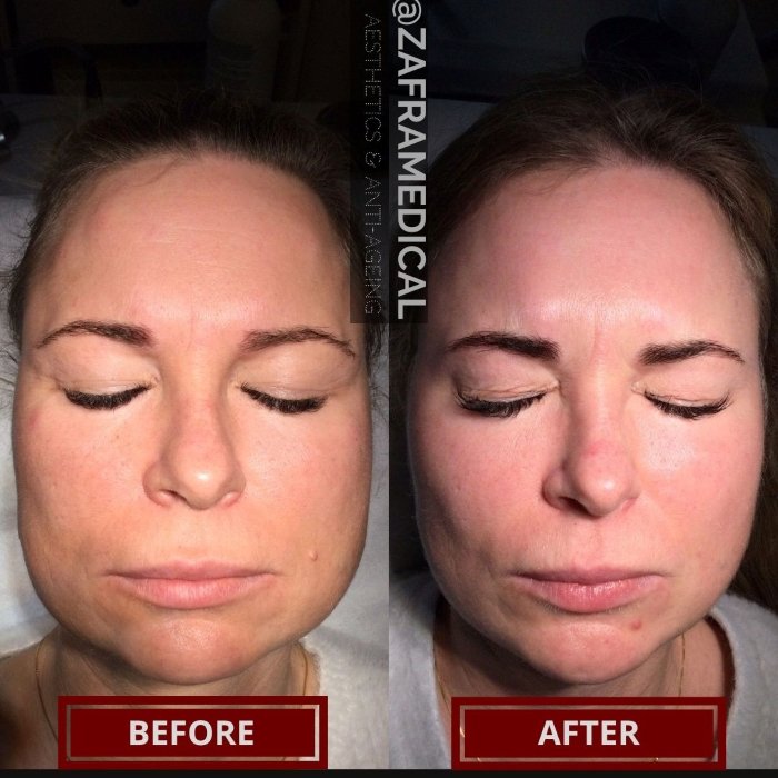Anti-wrinkle injection jaw slimming.jpg
