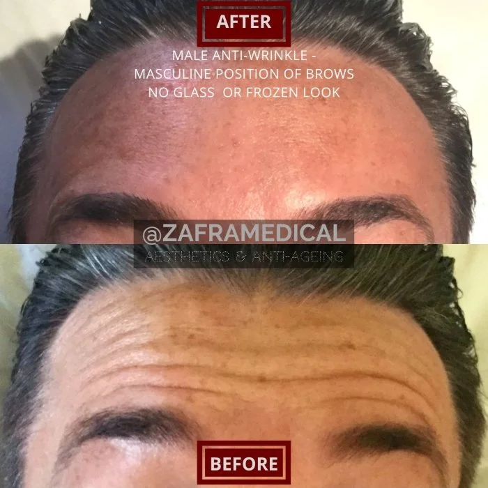 Anti-wrinkle injection Male forehead.jpg