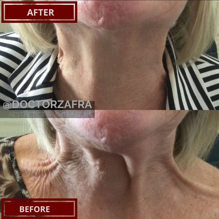 Anti-wrinkle injection neck bands.jpg