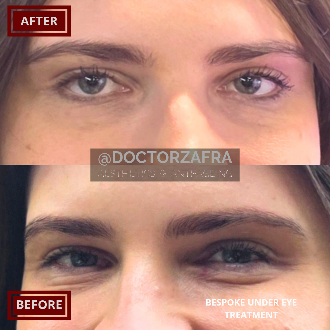 Anti-wrinkle injection Under eye wrinkles 1.png
