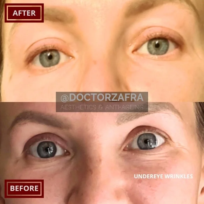 Anti-wrinkle injection Under eye wrinkles.jpg