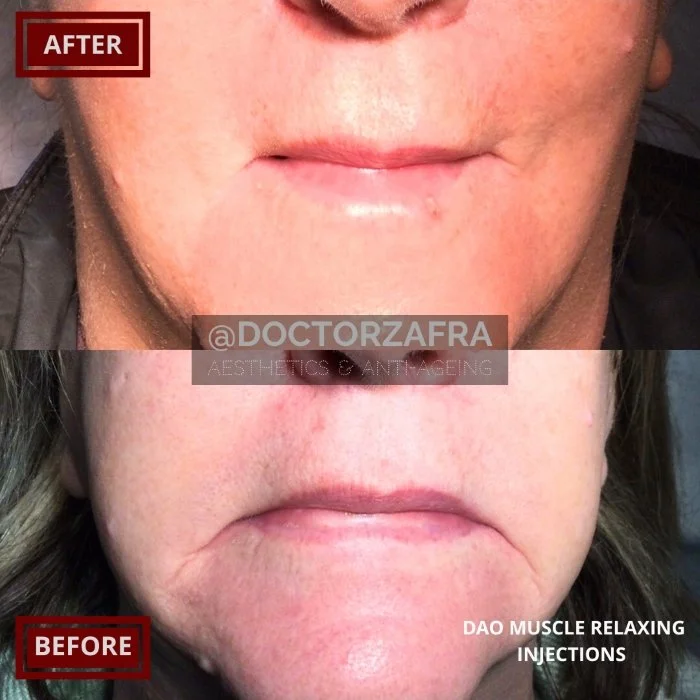 Anti-wrinkle Muscle relaxing injection DAO sad look downturn lips.jpg