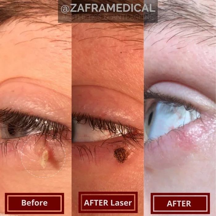 Benign Skin Lesion laser removal eyelid.jpg