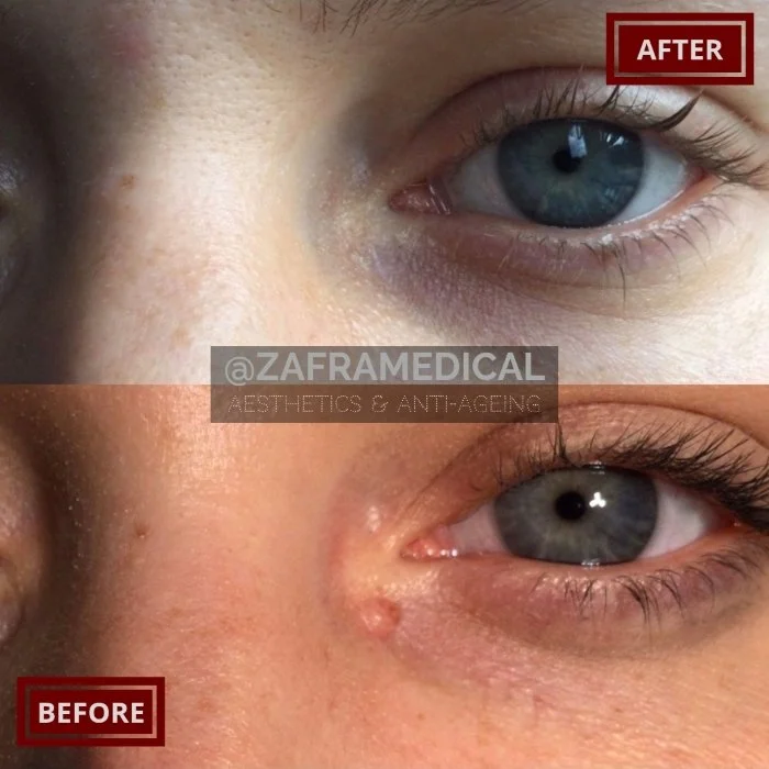 Benign Skin Lesion laser removal eye area.jpg