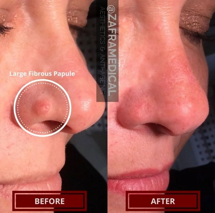 Benign Skin Lesion laser removal fibrous papule nose 2.jpg