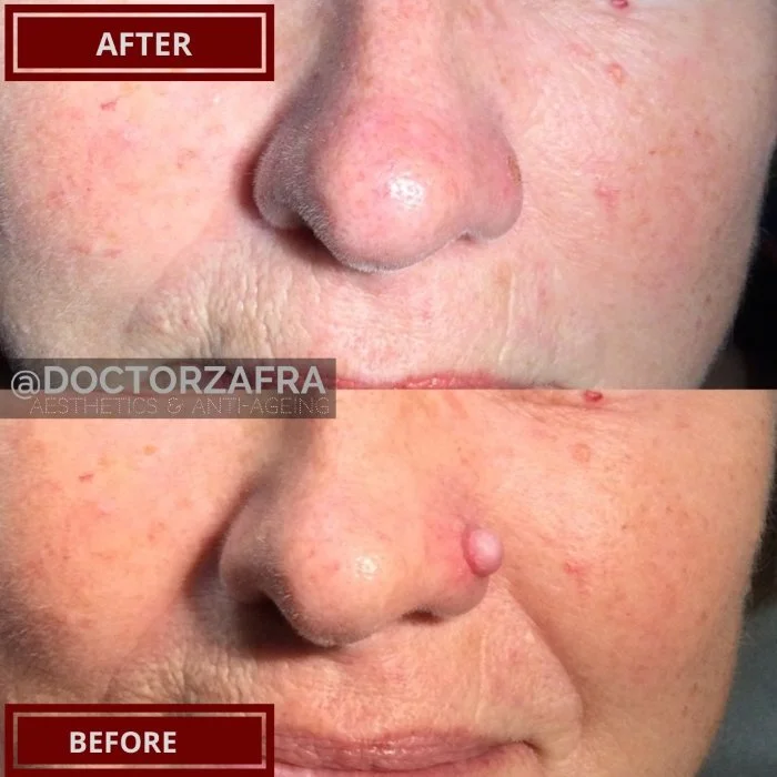 Benign Skin Lesion laser removal fibrous papule nose 3.jpg