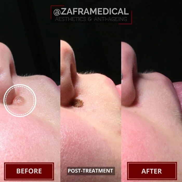 Benign Skin Lesion laser removal fibrous papule nose.jpg