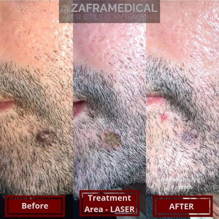 Benign Skin Lesion laser removal hairy mole chin.jpg