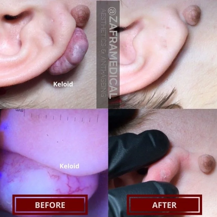 Benign Skin Lesion laser removal keloid ear.jpg