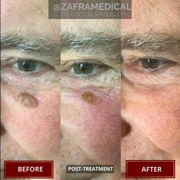 Benign Skin Lesion laser removal large mole cheek older man.jpg