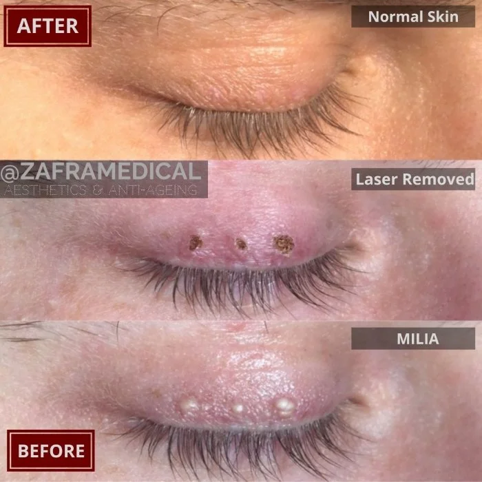 Benign Skin Lesion laser removal milia eye lid.jpg