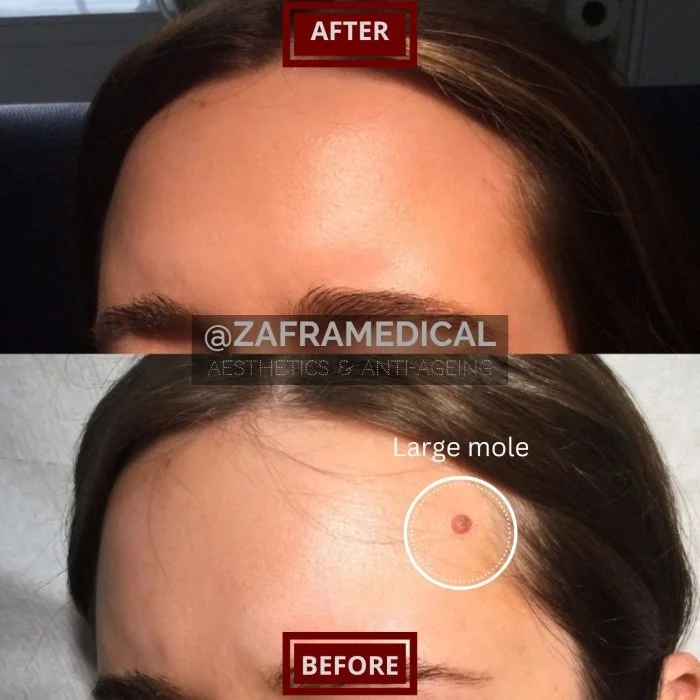 Benign Skin Lesion laser removal mole forehead.jpg