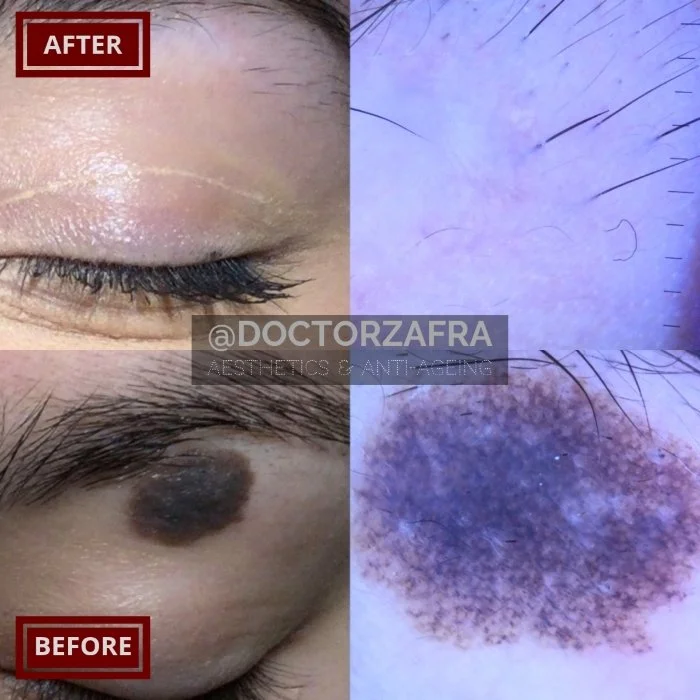 Benign Skin Lesion laser removal mole top eyelid eye area.jpg