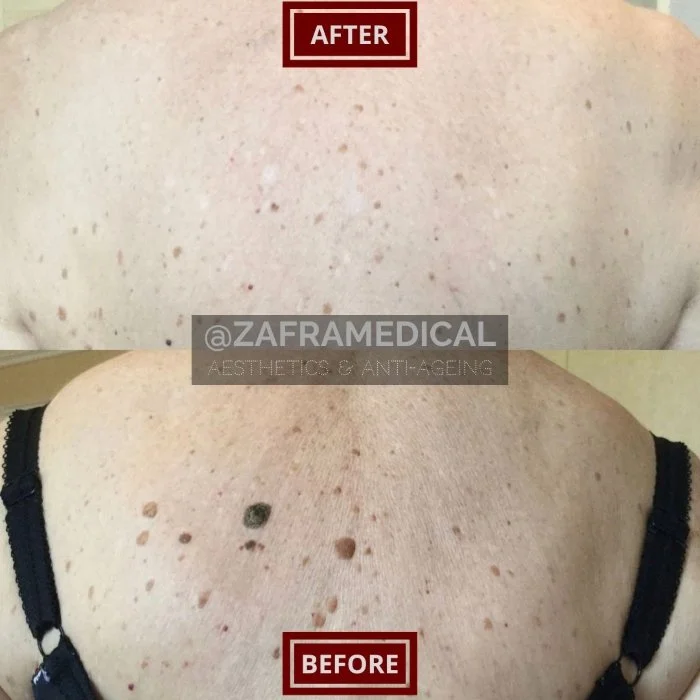 Benign Skin Lesion laser removal moles seborrheic keratosis.jpg