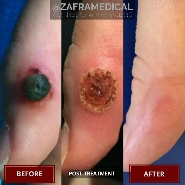 Benign Skin Lesion laser removal pyogenic granuloma hand finger.jpg